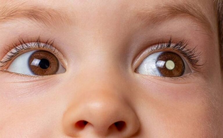 Retinoblastoma: Como identificar o cÃ¢ncer ocular infantil e proteger a visão das crianças