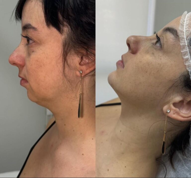 O preenchimento de mento é uma solução prática e segura para redefinir o contorno facial e melhorar a harmonia do rosto.