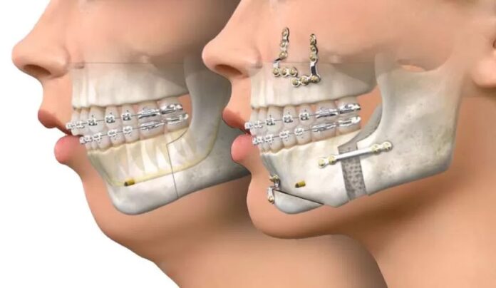 Paciente em pós-operatório de cirurgia ortognática, mostrando a recuperação e os benefícios do procedimento para a saúde e estética.