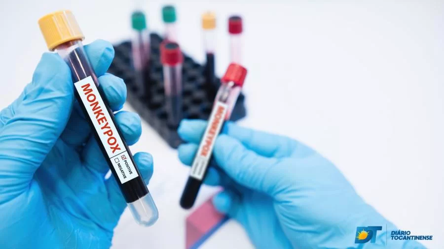 Monkeypox: sobe para 48 notificações de casos suspeitos da doença no Tocantins; 12 casos foram confirmado