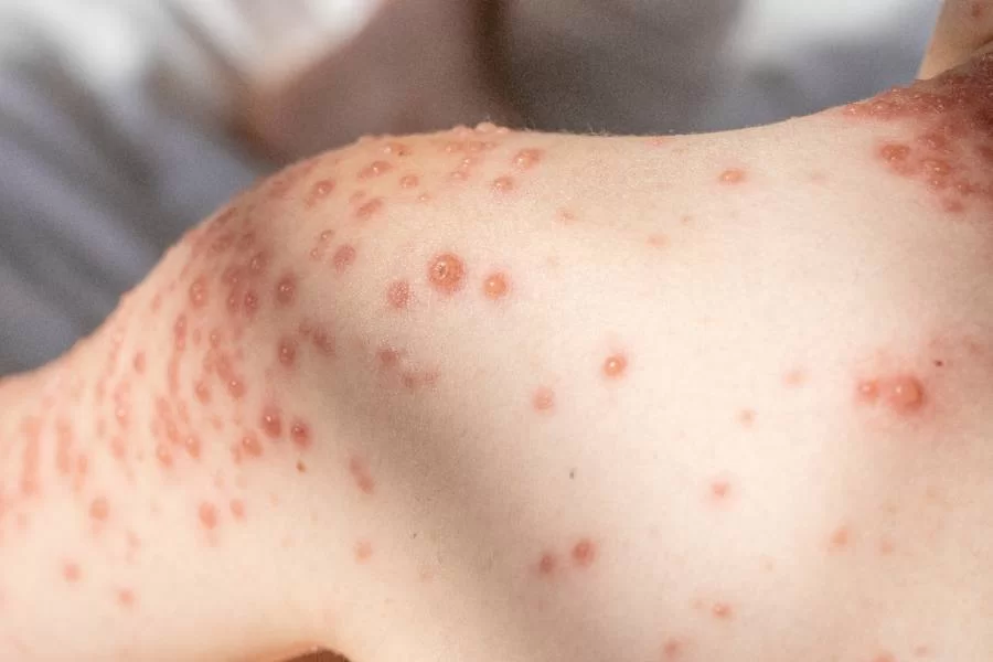 Monkeypox: Colinas do Tocantins tem um caso inconclusivo e quatro descartados