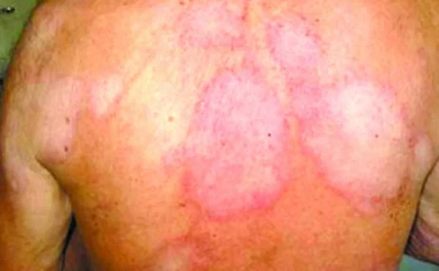 No Dia Estadual de Luta Contra a Hanseníase, Saúde reforça a importÃ¢ncia do diagnóstico precoce