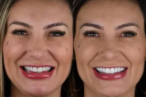 Andressa Urach investe R$ 35 mil reais em novo sorriso