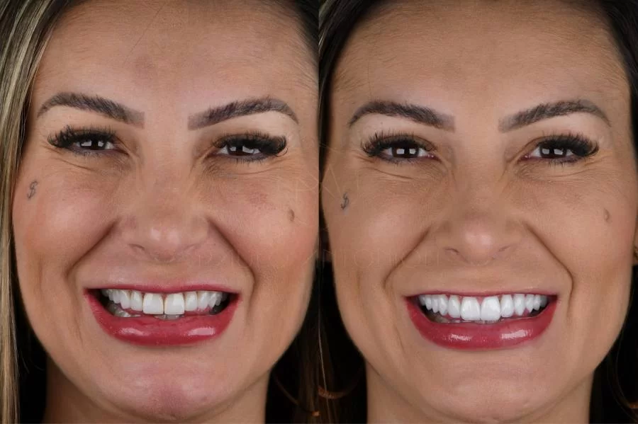 Andressa Urach investe R$ 35 mil reais em novo sorriso
