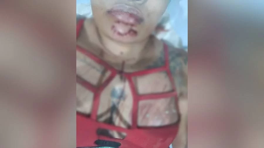 Motociclista cai em buraco no meio da rua e sofre graves ferimentos