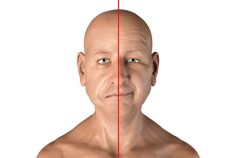 Paralisia de Bell: entenda a condição, causas, sintomas e tratamentos segundo especialistas