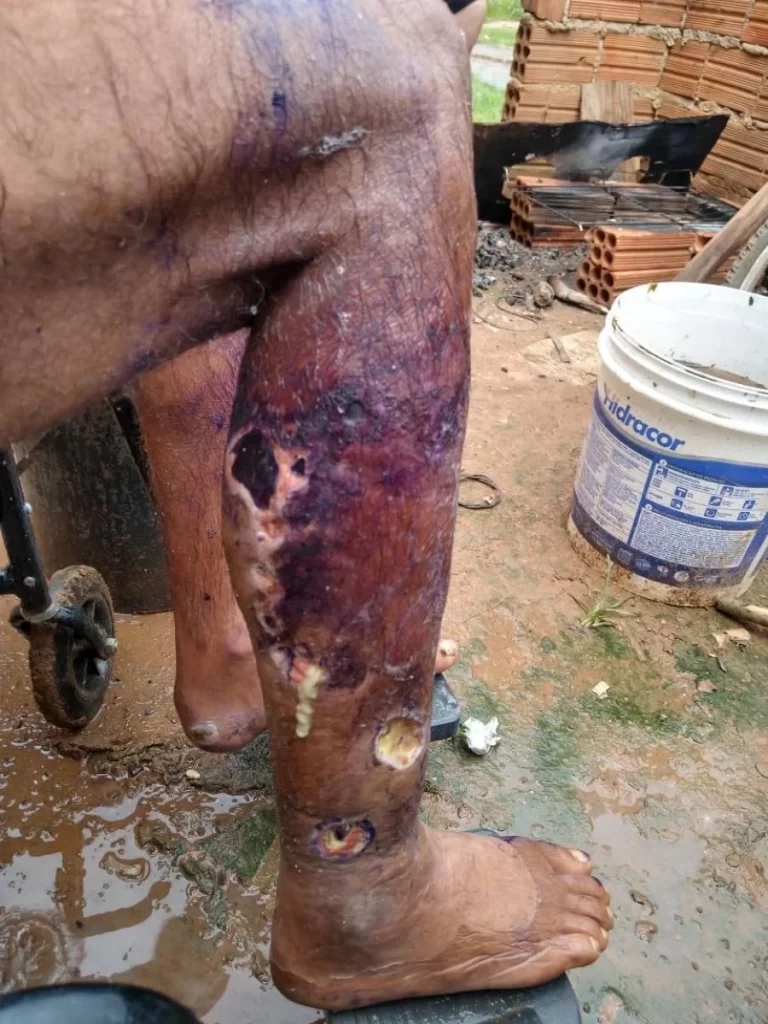 Homem com ferimento grave na perna se recusa a ter atendimento médico; acidente aconteceu após ter caído em vala na cidade de Colinas