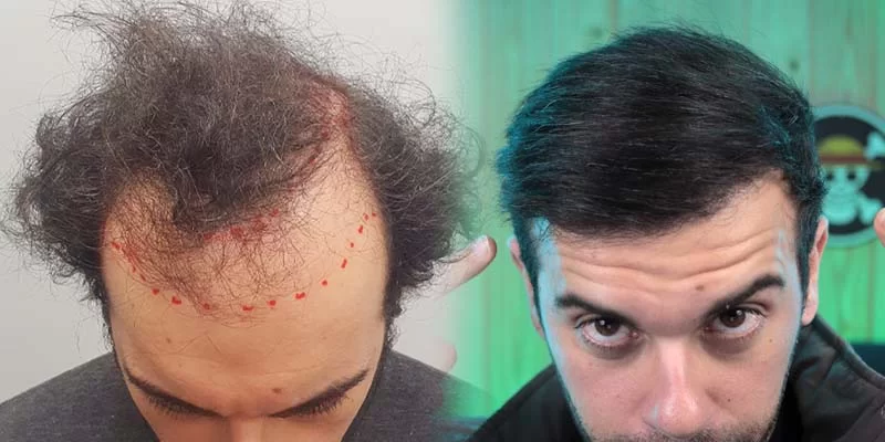 Transplante capilar: tudo o que você precisa saber sobre o procedimento, benefícios e riscos