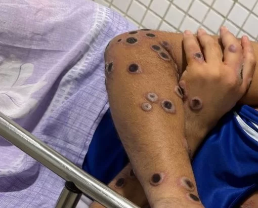 Mpox: Brasil registra 373 casos em 2025; Pará tem 19 casos e 2 óbitos