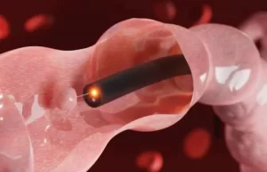 Colonoscopia: Para que serve? Como funciona?