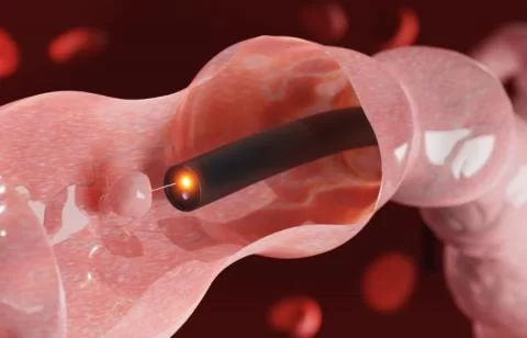 Colonoscopia: Para que serve? Como funciona?