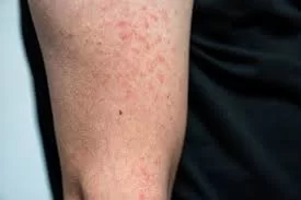 Surto de sarampo em Campos Lindos expõe queda vacinal no Tocantins; seis casos são confirmados e outros seis seguem em investigação