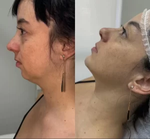 Preenchimento de mento: a nova tendência na estética facial não cirúrgica
