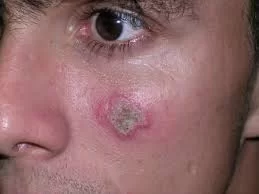 Fevereiro Roxo: Tocantins Avança na Conscientização e Apoio a Pacientes com Lúpus, Alzheimer e Fibromialgia