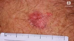 Doença basovascular: entenda causas, sintomas e cuidados necessários