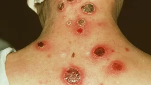 Sífilis no Tocantins: 630 casos confirmados em 2025, 75% entre gestantes