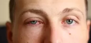 Conjuntivite: casos aumentam no Brasil e no Tocantins; especialistas explicam causas, sintomas e formas de prevenção