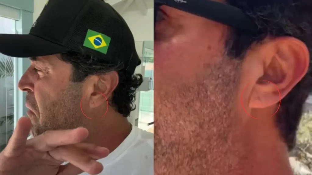 ‘Sinal de Frank’: a dobra na orelha que virou alerta após morte do influenciador Henrique Maderite e o que a ciência realmente diz