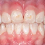 Manchas, sulcos e dentes frágeis: entenda o que é hipoplasia do esmalte e por que ela acontece