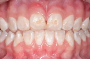 Manchas, sulcos e dentes frágeis: entenda o que é hipoplasia do esmalte e por que ela acontece