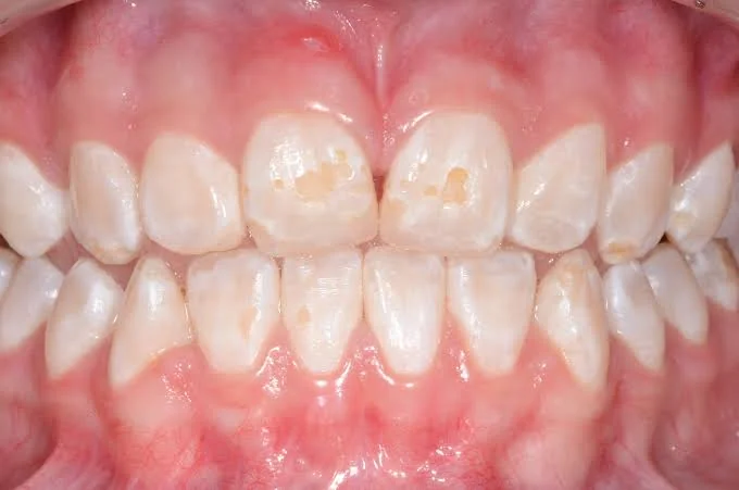 Manchas, sulcos e dentes frágeis: entenda o que é hipoplasia do esmalte e por que ela acontece