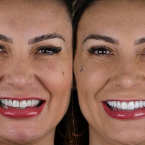 Andressa Urach investe R$ 35 mil reais em novo sorriso