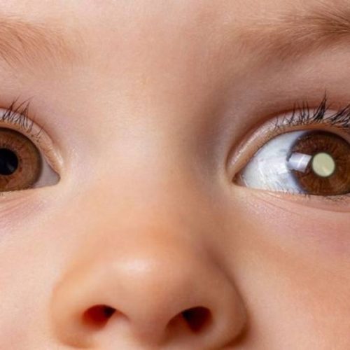 Retinoblastoma: Como identificar o cÃ¢ncer ocular infantil e proteger a visão das crianças